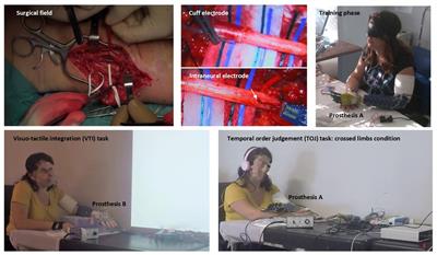 Sensory- and Action-Oriented Embodiment of Neurally-Interfaced Robotic Hand Prostheses